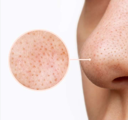 PORI DILATATI E PUNTINI