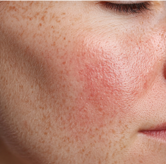 Pelle sensibile e barriera danneggiata